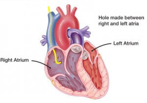 atrial-septostomy