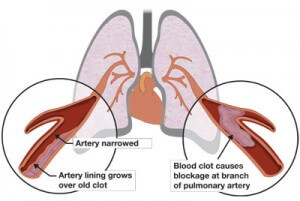 Pulmonary endarterectomy | PHA