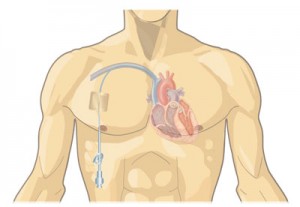 hickman-line