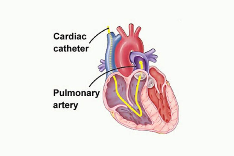 Catheterisation